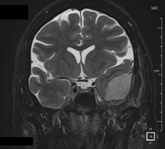 Méningiome - Tumeur intracrânienne androcur