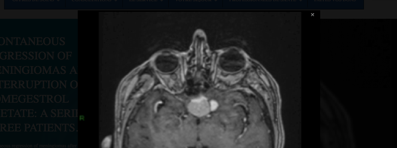 méningiome androcur